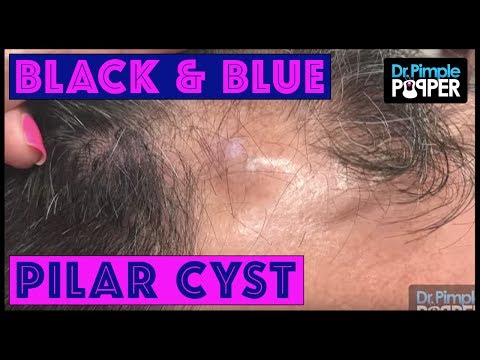 A Black & Blue Pilar Cyst