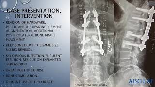 Pedicle Screw Loosening - The Role of Bacterial Biofilms in Chronic Implant-Associated Infection