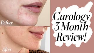 Curology Review: My Acne & Anti-Aging Results After 3 Months!