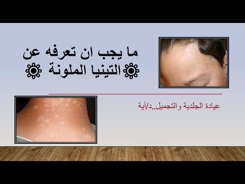 🔷🔶 التنيا الملونة ( المبرقشة ) 🔶🔷اسبابها 🔸 علاجها بالتفصيل 🔹Tinea versicolor