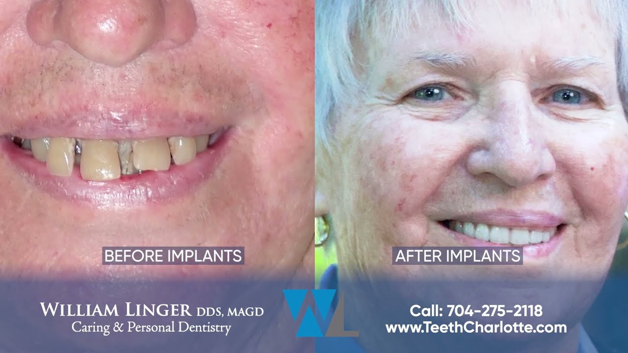 Charlotte Dental Implants Patient Testimonial Dr. William Linger, DDS