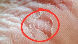 Why Can You Peel Dead Skin Off Your Fingers Without Pain?