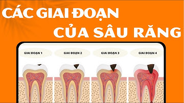 Các giai đoạn của sâu răng | Tt Niềng Răng quốc tế Diamond