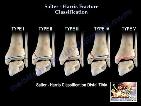 Salter Harris Fracture Classification - Everything You Need To Know - Dr. Nabil Ebraheim