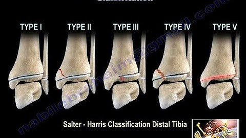 Salter Harris Fracture Classification - Everything You Need To Know - Dr. Nabil Ebraheim