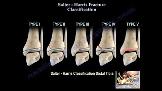 Salter Harris Fracture Classification - Everything You Need To Know - Dr. Nabil Ebraheim screenshot 2