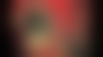 Post traumatic Aniridia    Open Sky Artificial Iris and Secondary IOL Implantation One Step Technique Cesare Forlini