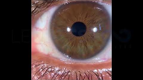 Quick Vue ® Smartphone Eye Imaging Adaptor