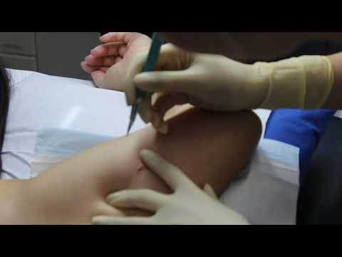 Video: 3 Cara Membuang Nexplanon