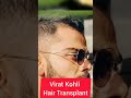 Virat kohli hair transplant  celebrity hair transplant  indian cricket team shorts