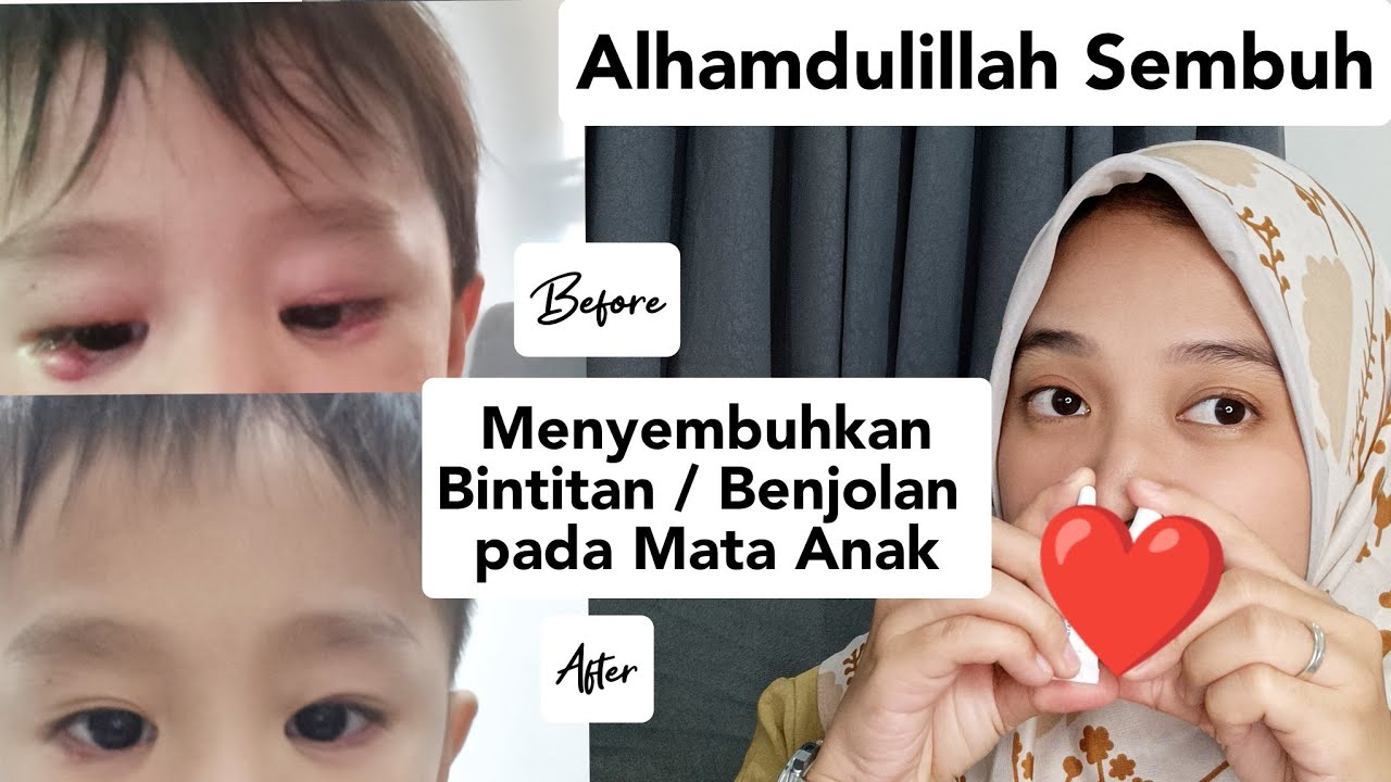 MENYEMBUHKAN BINTITAN ATAU BENJOLAN PADA MATA 
