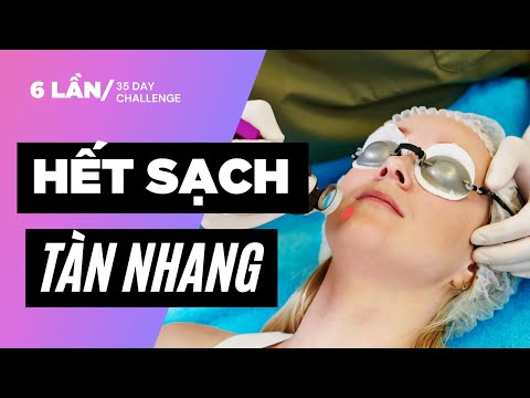 Cách trị tàn nhang hiệu quả và an toàn nhất bằng laser vô cực | Thái Phương Anh