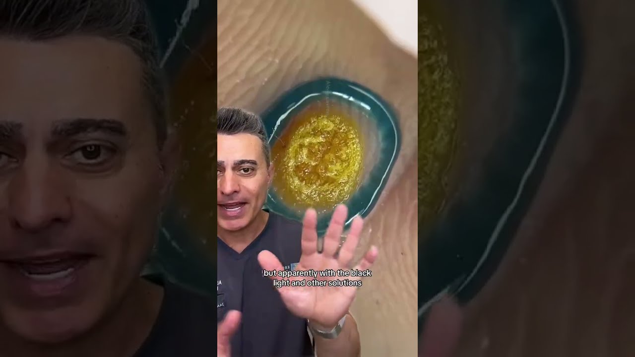 Will This Help Your Hand Warts 