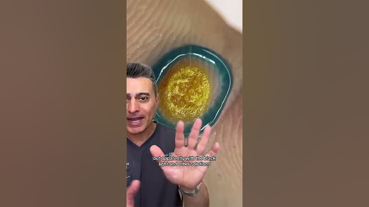 Will This Help Your Hand Warts?