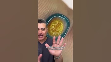 Will This Help Your Hand Warts?