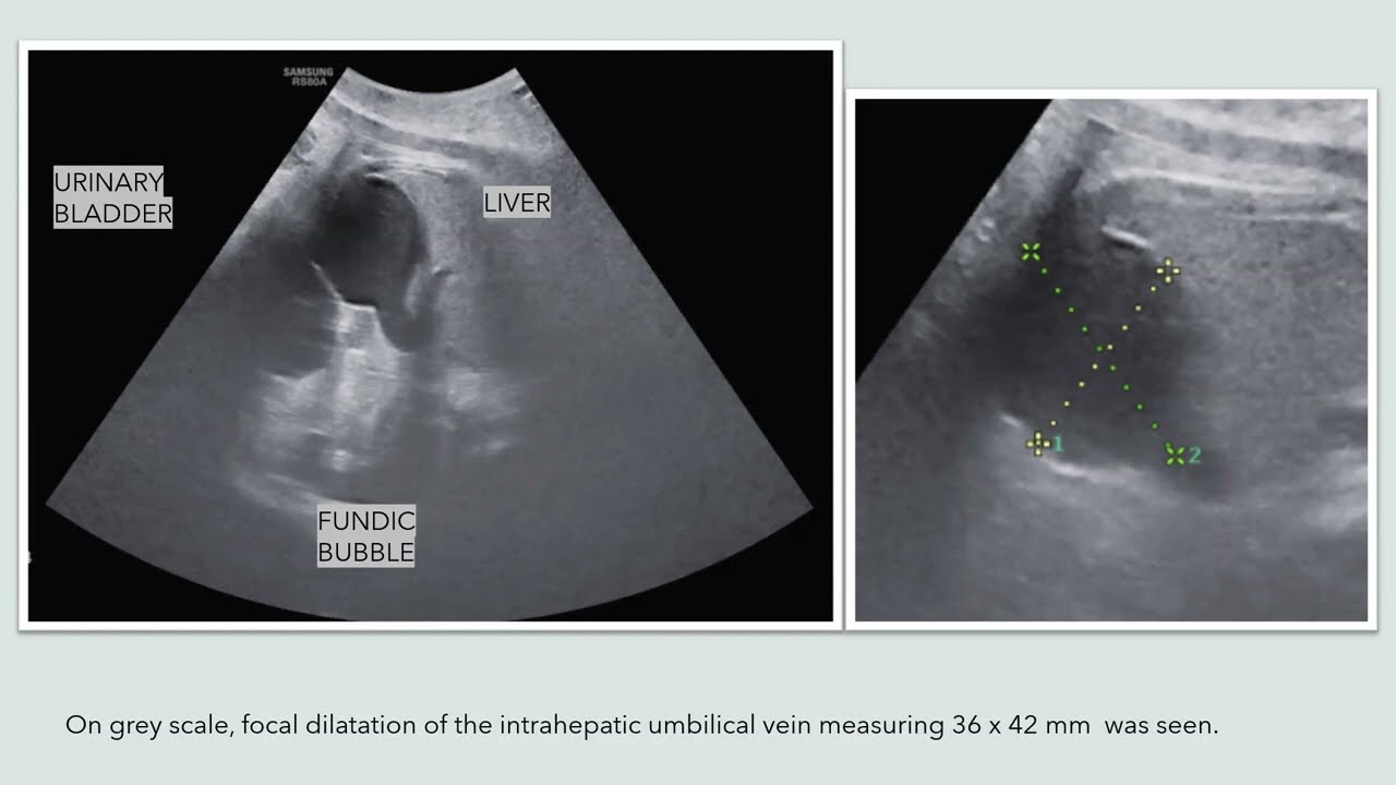 Umbilical Vein Varix Ultrasound