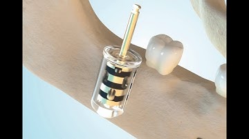 Bone Shell Harvesting example with the Easy Bone Collector