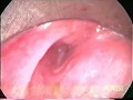 Fistule quatrime fente  4th branchial cleft fistula