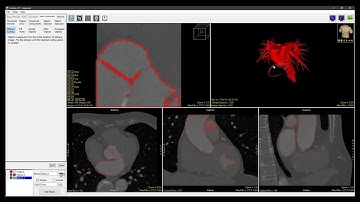 Analyze 15.0 - Segment: Oblique Cutting