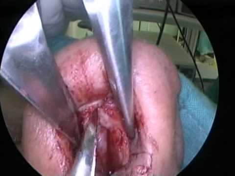 Live Surgery Course Of The Nose And Paranasal Sinuses - Operation 4 (part 1)