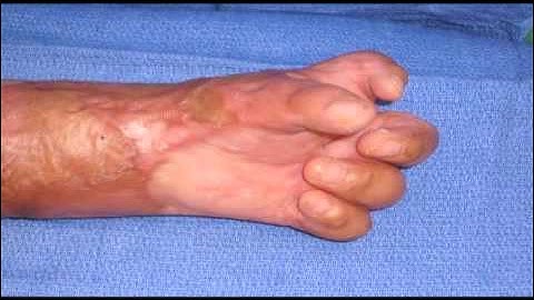 Dr. Paul Zidel, "Dupuytren