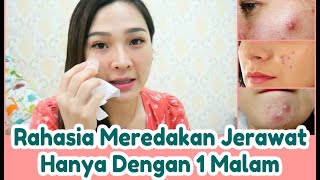 Menghilangkan jerawat menggunakan ES BATU !!