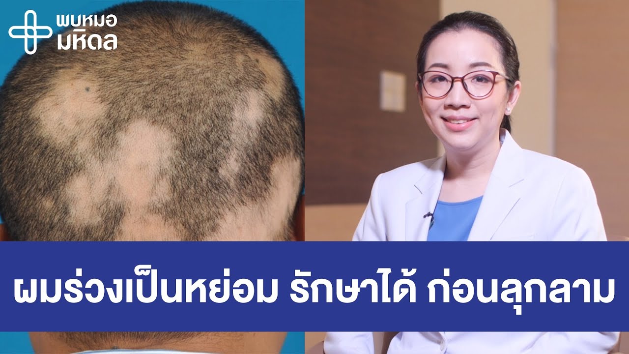 ผมร่วงเป็นหย่อม รักษาได้...ก่อนลุกลาม | พบหมอมหิดล [by Mahidol Channel]