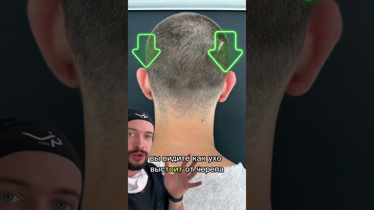 Коррекция лопоухости #shorts