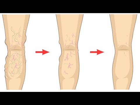 How to Get Rid of Varicose Veins Naturally