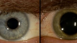 Ebola turns mans eye from blue to green
