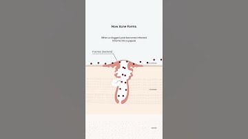 How Acne Forms