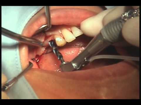 Megagen ExFeel Internal Live Surgery.avi