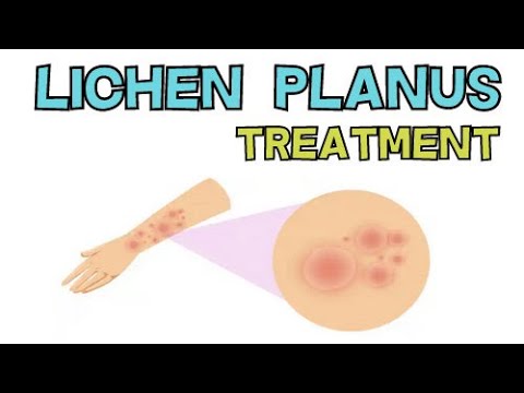वीडियो: लाइकेन प्लेनस का इलाज कैसे करें: 13 कदम (चित्रों के साथ)
