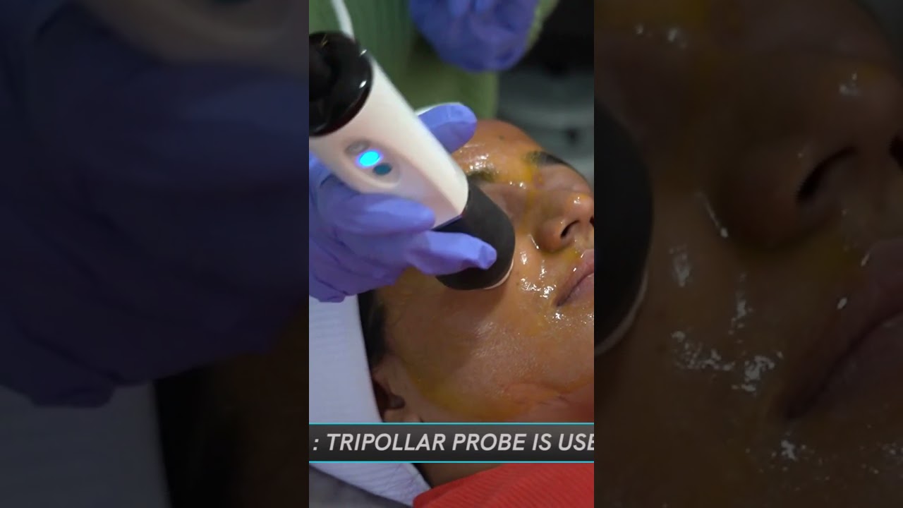 Oxygeneo 3 in 1 Superfacial | How Does it Works? | Dr. Avanti Pedamkar | Skin Specialist in Pune