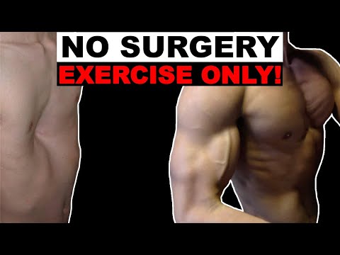 Pectus Excavatum Exercises (Fix it Without Surgery!)