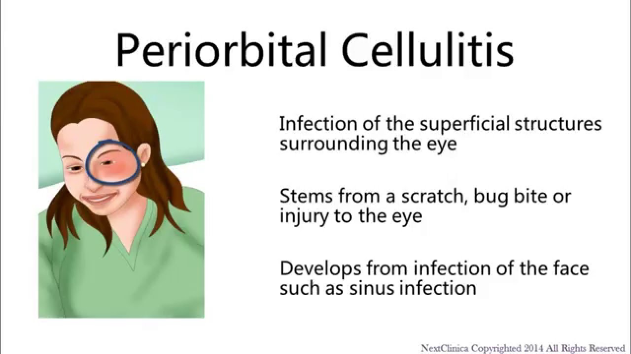 periorbital cellulitis contagious