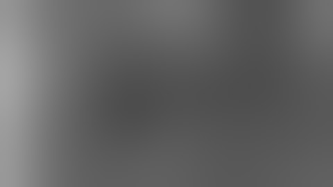 Mesohepatectomy (Klatskin 18yrs after gallbladder cancer)