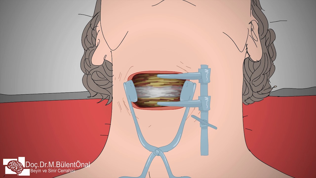 servikal mikrodiskektomi boyun fitik ameliyati animasyon videosu youtube