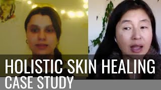 From Tears to Triumph: A Journey to Clear Skin with the Korean Clear Skin Formula by Hungry Gopher 49 views 2 months ago 10 minutes, 31 seconds