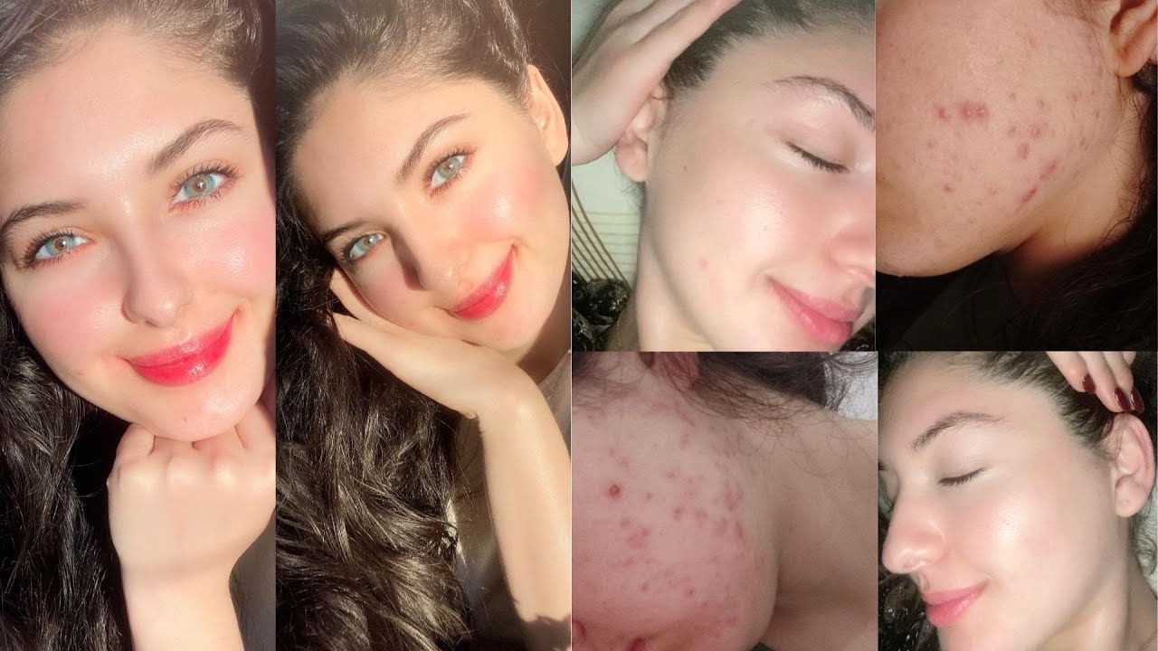 تجربتي مع أقوى دواء🤯لحب الشباب و النتيجة صادمة😱