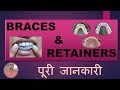 BRACES & RETAINERS, कौन सा Retainer सबसे अच्छा है, किस समय लगाना है, कितने समय लगाना है,खर्चा