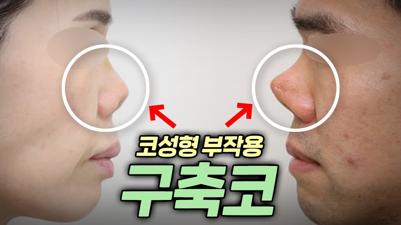 구축코 환자 90%가 놓치는 핵심