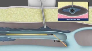 Radiofrequency Fibre In Action - RFA Vein Treatment