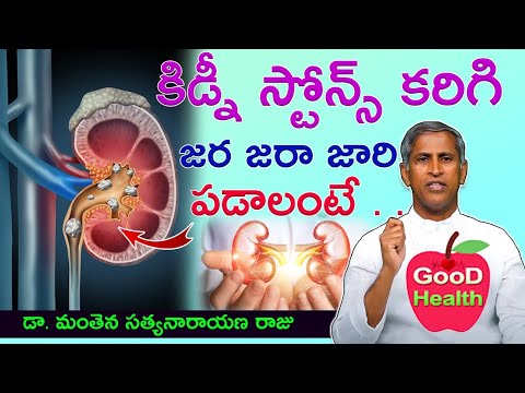 కిడ్నీ స్టోన్స్ కరిగిపోవాలంటే|Kidney Stone Treatment at Home|Manthena Satyanarayana Raju|GOOD HEALTH