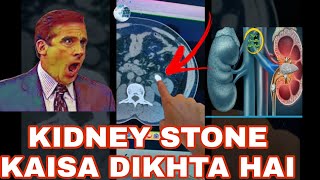 What does a kidney stone look like? #ctscan #radiology #radiography