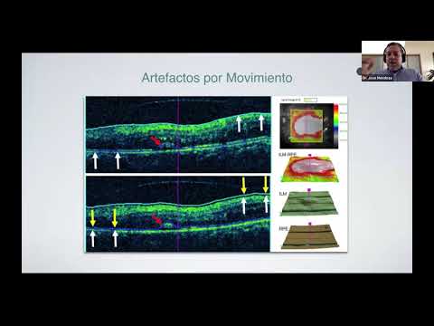 Video: Regressione Della Neovascolarizzazione Cuxididapapillare Coroidale Nella Sindrome Del Punto Bianco Evanescente Multiplo Mediante Angiografia Con Tomografia A Coerenza Ottica: Un Ca