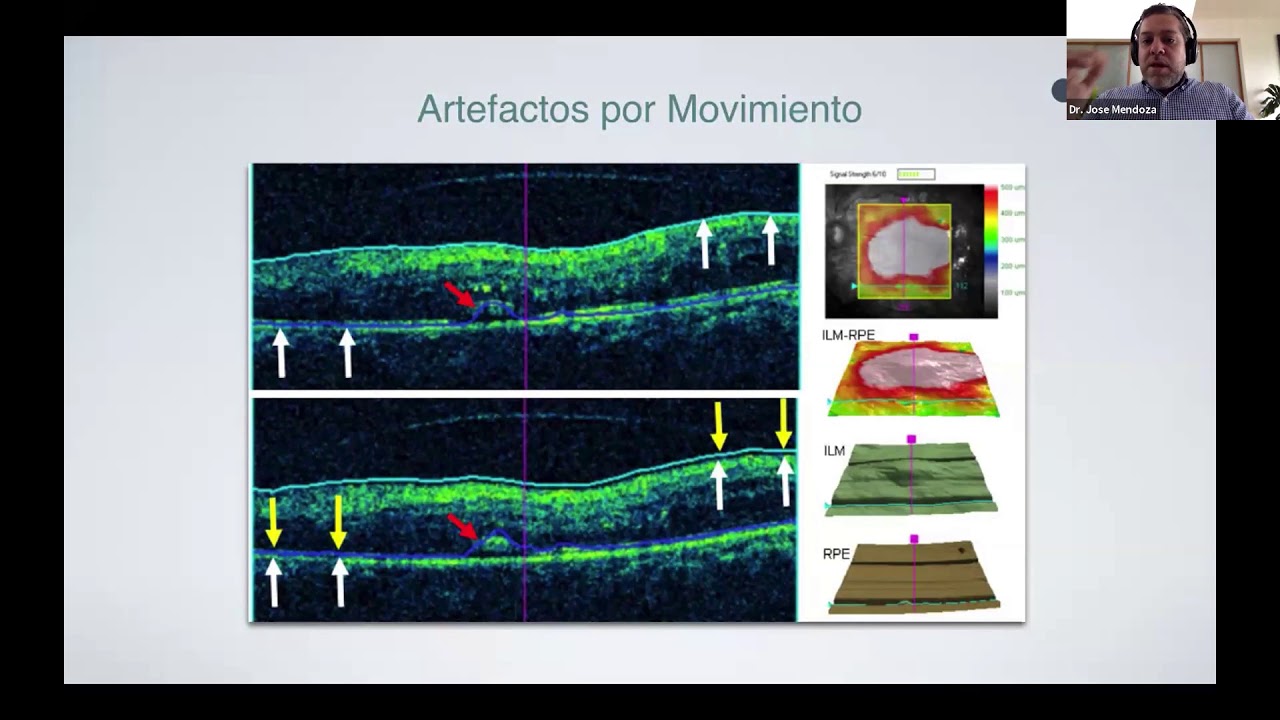 Conferencia: OCT y OCT Angiografia YouTube Conferencia: OCT y OCT Angiografia YouTube