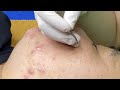 Acne Hidden On The Skin | Làm Sạch Mụn Ẩn Trên Da #thuytruong58