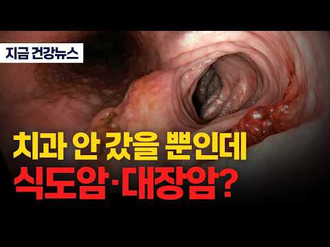 치과 안 갔을 뿐인데 식도암•대장암?