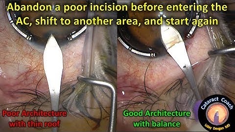 If your cataract surgery incision starts out poor, stop and try again
